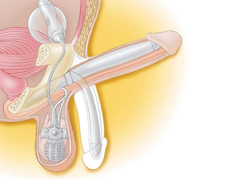  AMS 700™ penisprothese