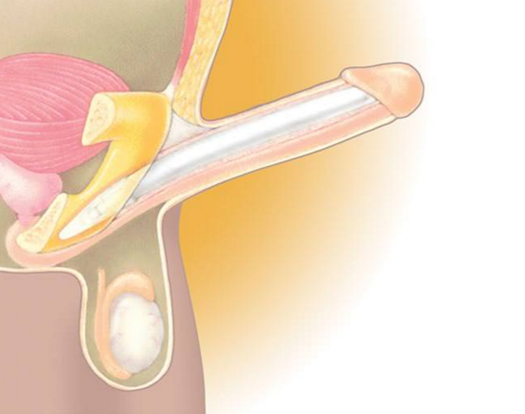  Spectra™ verbergbare penisprothese