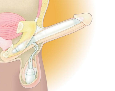 AMS Ambicor™ penisprothese