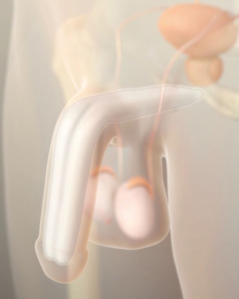 ANIMATIE AMS AMBICOR PENISPROTHESE