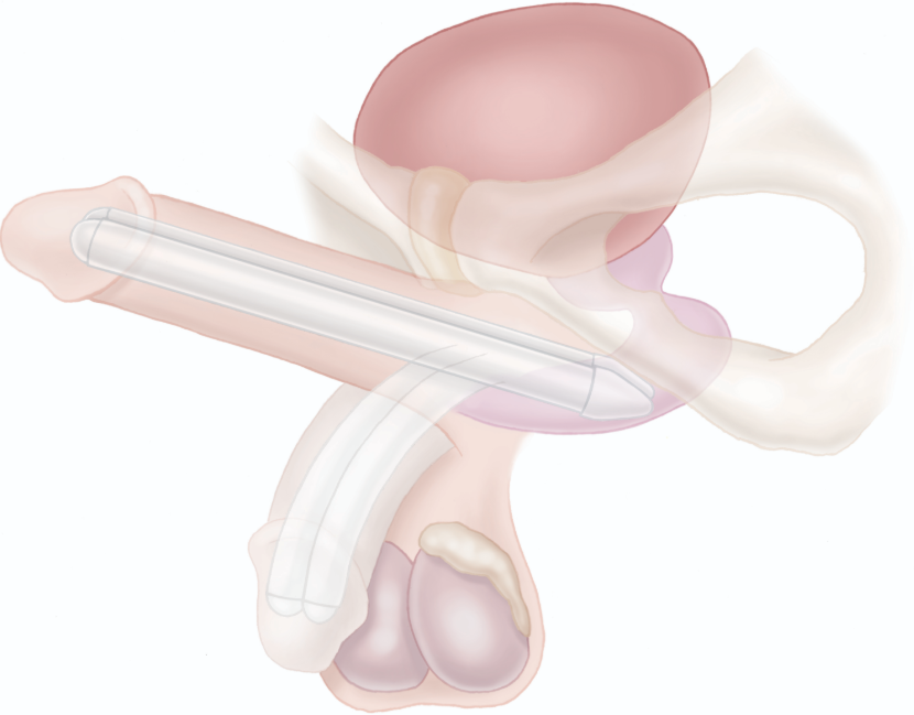 Illustratie tactra penisprothese.