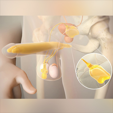 Ams700 penisimplantaat video animatie.